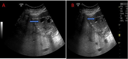Abdominal ultrasound: Multi loculated cystic mass of the left lobe, stage III of Gharbi (blue arrow).