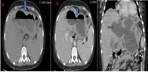 Abdominal CT scan in axial (A, B) and coronal (C) sections without intravenous contrast media: Large cystic mass of the left liver with thickened wall, and air fluid level (blue arrow) next to the stomach (blue star) with a lymphadenopathy (black arrow).