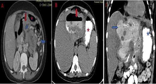 Abdominal CT scan in axial (A) sections with intravenous contrast media: Visualization of a fistula (red arrow) between the cyst (blue star) of the left liver and the stomach (red star). It is associated with compression of the splenic vein and collateral venous circulation (blue arrow). After oral contrast administration (abdominal CT in axial (B) and coronal (C) section): Visualization of contrast product in the cyst.