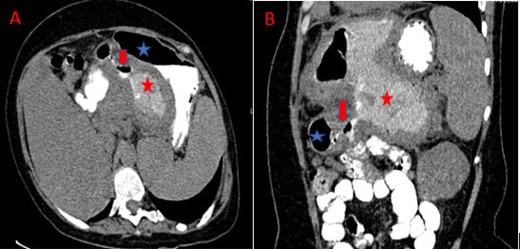 Abdominal CT after axial (A) and coronal (B) oblique reconstructions and oral contrast administration: Visualization of the fistula track (red arrow) between the stomach (blue star) and the cyst with passage of the contrast agent into the cyst (red star).