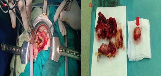Intraoperative exploration of the cyst and resection of the protruding dome +wedge gastric resection. Image of girl gallbladder (red Arrow).