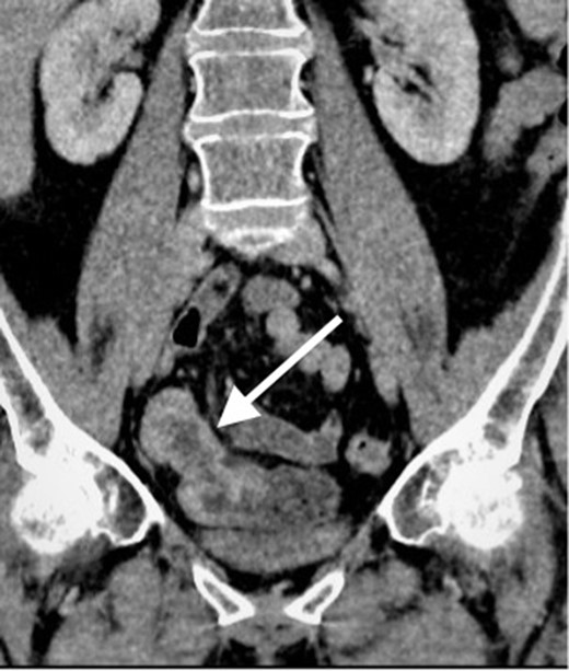 Contrast enhanced CT scan of the abdomen and pelvis in coronal plain demonstrating an approximately 10 cm segment of terminal ileum which shows mural thickening and mild mural hyperenhancement. No locoregional lymphadenopathy or proximal small bowel dilatation.