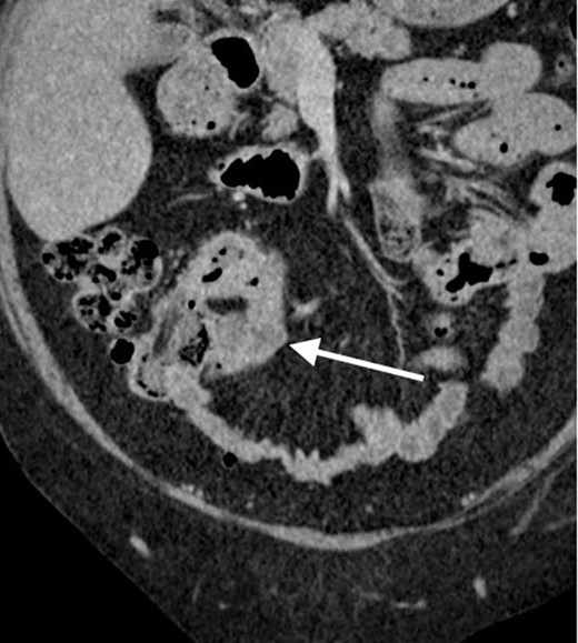 Contrast enhanced CT scan of the abdomen and pelvis in coronal plain demonstrating the previously known segment of terminal ileum which now showing more prominent mural thickening and mild hyper enhancement. No locoregional lymphadenopathy or proximal small bowel dilatation.