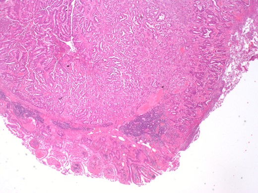 Histopathology sample from the terminal ileum showing moderately differentiated adenocarcinoma in the terminal ileum. Tumour infiltrates 4 mm the beyond the muscularis propria.
