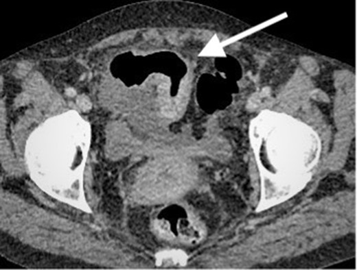 Contrast enhanced CT scan of the abdomen and pelvis in axial plain demonstrating an approximately 8 cm segment of terminal ileum which shows mural thickening and hyperenhancement. No locoregional lymphadenopathy or proximal small bowel dilatation. Small volume free fluid present.