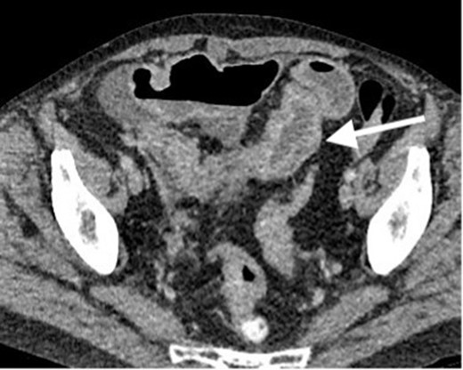 Contrast enhanced CT scan of the abdomen and pelvis in axial plain demonstrating persistent mural thickening of the terminal ileum which shows mural thickening and hyperenhancement. No proximal small bowel dilatation. Small volume free fluid seen on previous study mostly resolved. However, there are few borderline ileocolic lymph nodes and subtle peritoneal nodules (not demonstrated on this image).