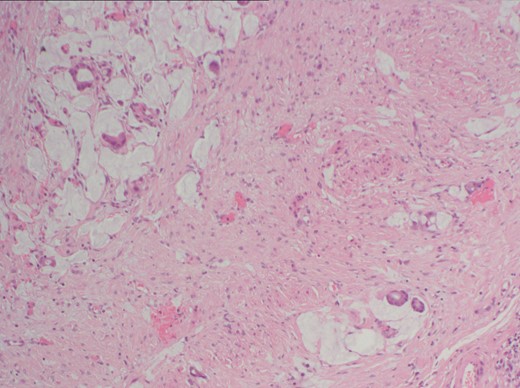Histopathology sample of peritoneal biopsies showing poorly differentiated adenocarcinoma. There is infiltration of the subserosal fibrous tissue by a population of atypical epithelial cells arranged as single cells and glandular structures with evidence of mucin production.