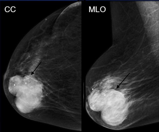 Mammographic CC and MLO views of a large oval circumscribed mass.