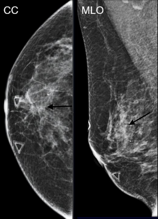 Mammographic CC and MLO views of an irregular indistinct mass.
