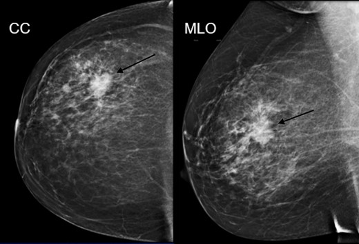 Mammographic CC and MLO views of an irregular spiculated mass. Pathology: Low-grade adenosquamous carcinoma