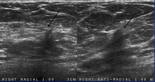 Ultrasound images in the right breast at 1:00, 3 cm from the nipple demonstrates an irregular hypoechoic mass with angular margins.