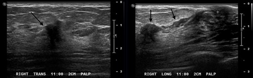 Ultrasound images in the right breast at 11:00, 2 cm from the nipple demonstrates an irregular indistinct hypoechoic mass with an associated dilated duct extending toward the nipple.
