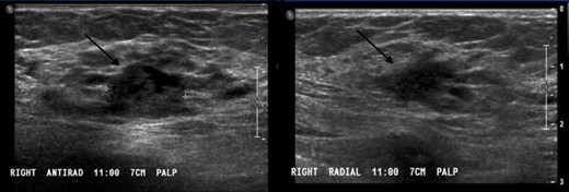 Ultrasound images in the right breast at 11:00, 7 cm from the nipple demonstrates an irregular indistinct hypoechoic mass.