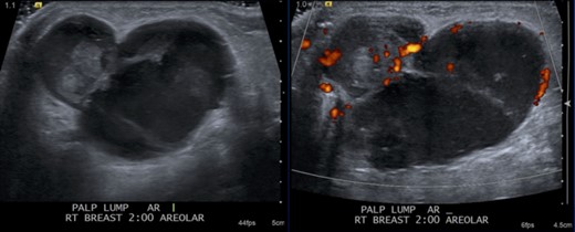 Ultrasound images in the right breast at 2:00, subareolar demonstrates a circumscribed mixed solid and cystic mass with increased internal vascularity.