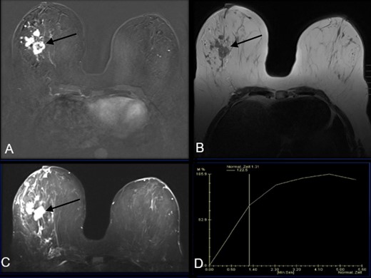 A- MRI subtraction post-contrast image demonstrates an irregular rim enhancing mass in the right outer middle depth breast. (B)- MRI T1 weighted image demonstrates a T1 hypointense irregular mass (C)- MRI T2 weighted image demonstrates a T2 hyperintense irregular mass (D)- MRI kinetic curve demonstrating Type 1 or persistent kinetics of this irregular mass