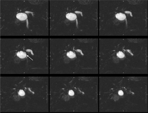 Post-oral contrast T2-weighted coronal MRCP images (SPACE 1mm with reformat) showed anatomical communication between the concerned cystic hepatic lesion near the confluence and right intrahepatic duct (white arrow).