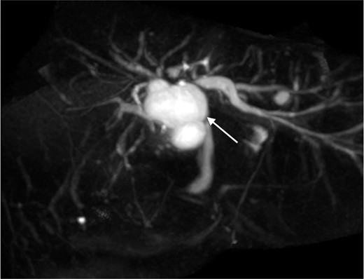 MRCP maximal intensity projection showed anatomical communication between the concerned cystic hepatic lesion near the confluence and right intrahepatic duct (white arrow).