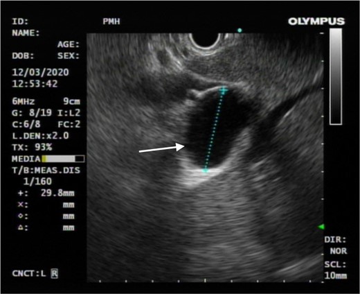 Endoscopic ultrasound showed no anatomical communication between the concerned cystic hepatic lesion and the biliary system (white arrow).