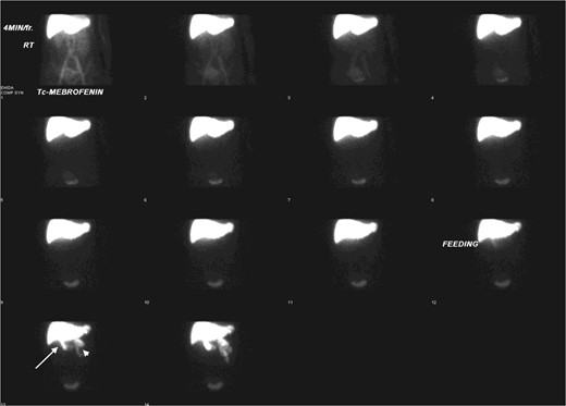 Hepatobiliary scintigraphy showed good hepatic tracer extraction with transit into gallbladder (white arrow) and intestine (white arrow head) during the first hour.
