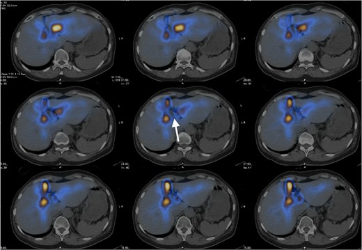 Hepatobiliary scintigraphy with SPECT/CT fusion images showed focal photopenia in the concerned cystic hepatic lesion (white arrow), suggestive of no communication with the biliary system.