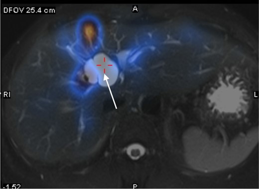 Manual co-registration of MRCP and SPECT images showed no tracer uptake in the concerned T2 hyperintense cystic hepatic lesion (white arrow).