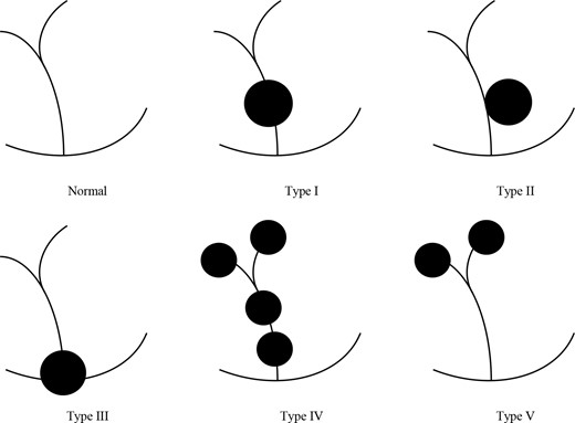 Todani classification of choledochal cysts. Type I are cystic dilation of the extrahepatic duct. Type II are juxtaposed to the common bile duct. Type III are characterised by their intraduodenal location at the pancreatic obiliary junction. Type IV are multiple lesions involving extrahepatic duct with or without intrahepatic involvement. Type V can be single or multiple intrahepatic saccular or fusiform dilatation.