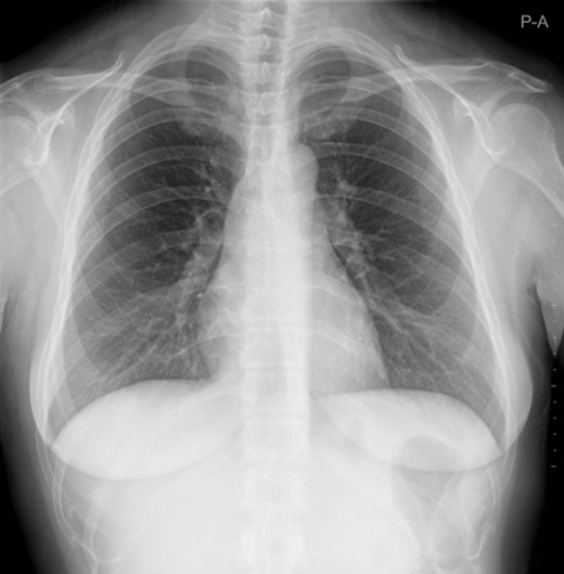 Chest X-ray was normal.
