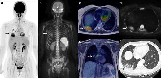 Maximal intensity projection images of FDG PET (a) and DWI (b), transaxial and coronal FDG PET/T2 weighted MR fusion images (c and d) and transaxial DWI (e) show an FDG-avid and high-intense pulmonary lesion (arrows) and FDG-avid ipsilateral hilar and mediastinal nodes (dotted arrows). High-resolution CT performed 2 days later (f) shows consolidation in right lung base periphery surrounded by ground-glass opacities consistent with COVID-19 pneumonia (arrow). DWI, diffusion-weighted imaging; FDG, fluorodeoxyglucose; PET, positron emission tomography