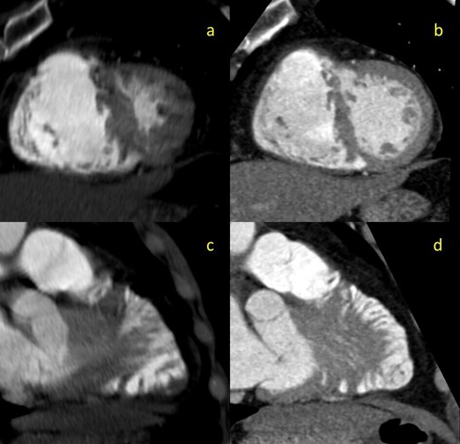 2-mm thick multiplanar reformation (MPR) images of the interventricular septum in cross-sectional (a, b) and lengthwise (c,d) orientations. Images on the left (a,c) are derived from the initial non-gated CTA. Images on the right (b,d) are derived from the follow-up gated-CTA exam