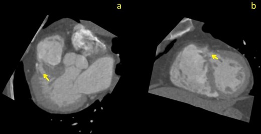 Curved planar reformation (CPR) images through the largest septal defect (arrows); images (a) pseudo-three chamber view; (b) pseudo-short axis view