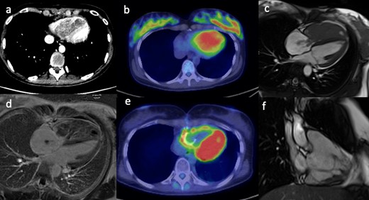 (a) Contrast-enhanced CT scan shows an ill-defined low density mass in the right ventricle. (b) The PET/CT fused image shows corresponding markedly increased avidity of the right ventricular mass. (c) Still frame from SSFP, CMR 4-chamber cine image shows a large mass filling the entire right ventricle with extension of small stalks through the tricuspid valve into the right atrium. (d) The late gadolinium enhanced image shows mild heterogeneous enhancement of the mass with some necrotic areas. (e) Post-operative PET/CT shows persistent avidity in the right ventricular wall. (f) Post-operative, still frame from right ventricular SSFP 3-chamber cine image shows residual irregular mass attached to the inferior right ventricular wall. CMR, cardiac magnetic resonance; PET, positron emission tomography; SSFP, steady-state free precession.