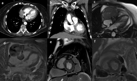 (a, b) CTPA showed an irregular filling defect in the right atrium. The CMR scan acquired 2 months after the CTPA of the same patient. The still frames from SSFP CMR cine 4-chamber (c) and the corresponding late gadolinium image (d) with the short-axis (e) image showing a large ovoid mass adjacent to the right atrium and attached to the right atrioventricular groove, invading into the right atrium. There are also two additional pericardial masses on the left lateral side, not invading into the myocardium, which showed heterogeneous, mild patchy gadolinium uptake on late gadolinium imaging (f). CTPA, CT pulmonary angiogram; CMR, cardiac magnetic resonance; SSFP, steady-state free precession.