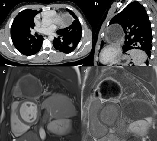 (a, b) Contrast-enhanced CT showing a large left upper lobe lung mass without a clear fat plane between lung and pericardium. Still frame from the short-axis SSFP CMR cine sequence (c) and corresponding late gadolinium enhancement image (d), showing the lung mass abutting the pericardial surface of the anterior-lateral left ventricular wall. CMR, cardiac magnetic resonance; SSFP, steady-state free precession.