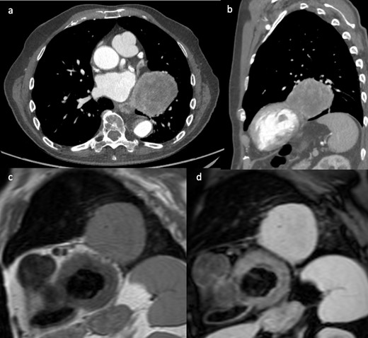 (a, b) Contrast-enhanced CT showed a large retrocardiac left lung mass adjacent to the left ventricular pericardium, raising suspicion of cardiac invasion. T1 weighted (c) and T2 weighed with fat saturation (d) short-axis CMR images showing separation of the mass from the myocardium with a thin pericardial fatty layer. Complete resection of the mass was achieved. CMR, cardiac magnetic resonance.
