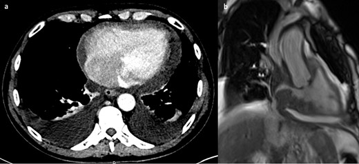 (a) Contrast-enhanced CT showing small a pericardial effusion, moderate bilateral pleural effusions and a filling defect in the right atrium. (b) Still frame from right ventricular SSFP 3-chamber cine image, showing grossly irregularly thickened atrial walls. The mass extends to involve the venae cavae and causes obstruction to flow of the superior vena cava. SSFP, steady-state free precession.