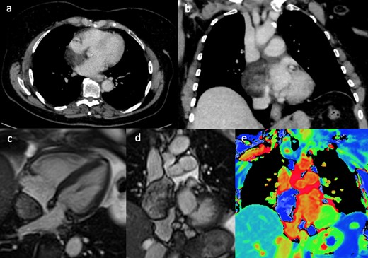 (a & b) Contrast enhanced CT showed an extra atrial but intra pericardial filling defect with fat density. Still frames of SSFP 4-chamber (c) and coronal (d) cine images, showing an extra cardiac mass abutting the right atrium and located into the venae cavae. The corresponding coronal T1 mapping image (e) showing (blue) fat signal within the mass. SSFP, steady-state free precession.