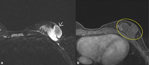 A and B. MRI images of left breast with contrast. (A). T2-weighted axial fat-suppressed sequence. Arrow shows a lobulated cystic multioculated mass in the left lower outer breast measuring 4.9× 2.7 × 5.6 cm superior to the patient’s scar consistent with lymphatic malformation. (B). T1 axial postcontrast and fat-suppressed sequence. No significant internal enhancement. Minimal rim enhancement. Mass goes to skin and close proximity to chest wall without invasion.