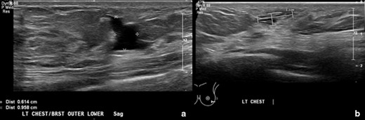 A and B. Ultrasound images of the left breast from 6-month follow-up after sclerotherapy and a two-year follow-up. (A). Image shows the left breast/chest wall lymphatic malformation status postsclerotherapy treatment. There is an irregularly shaped anechoic lesion in the left lower outer breast measuring 1.3 × 0.6 × 1.0 cm. No internal flow with color Doppler. (B). Image shows the left breast/chest wall lymphatic malformation after a two-year follow-up. There are small, irregularly shaped anechoic lesions within the outer lower left breast and within the chest wall inferior to the left breast. The portion within the left breast measures 1.1 × 0.4 cm. There is a decrease in size of the left breast/chest wall lymphatic malformation compared to 1.3 × 0.6 cm previously. There is no macrocystic component as well as seen on the prior ultrasound. No internal vascular flow is noted by color Doppler.