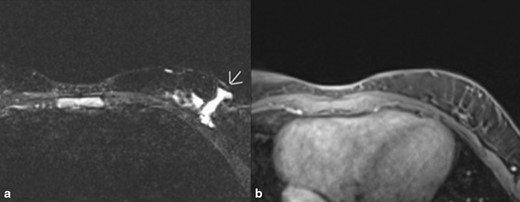 A and B. MRI images of left breast with contrast most recently. (A). Image shows recurrence of lymphatic malformation. Impression was overall benign with 2.6 × 0.5 cm serpinginous area of T2 hyperintense signal in the lower outer quadrant of the left breast with hyperintense T2 signal extending inferolaterally with the distal aspect excluded by collimation. These findings are located at the surgical bed and are suspicious for residual disease. (B). T1 weighted fat-suppressed contrast-enhanced sequence no significant enhancement.