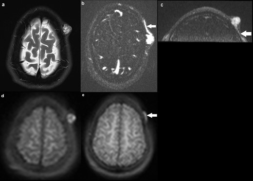 a) Axial T2 image demonstrating a 18 × 16 mm hyperintense subcutaneous lesion in the left frontal scalp region, with multiple flow voids within. Underlying calvarium is intact; (b) axial MRA (TWIST) demonstrating robust early (arterial phase) enhancement of the lesion, with a draining vein shown at the same level (solid arrow). No communication with the intracranial circulation; (c) coronal MRA delineating an arterial feeder arising from the left superficial temporal artery (solid arrow); (d) axial ASL image demonstrating hyperintensity within the lesion, suggestive of high flow; (e) axial ASL image at a different slice delineating the draining vein (solid arrow), with the arterial feeder seen on MRA not identified. ASL, arterial spin labeling.