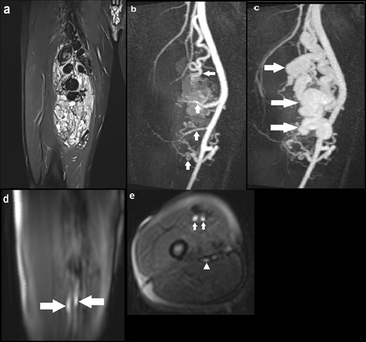 (a) Coronal STIR image demonstrating a large AVM with multiple large tortuous flow voids involving the vastus medialis and intermedius muscles; (b) coronal MIP image of dynamic MRA (TWIST) in the early arterial phase delineating four arterial feeders arising from the proximal, mid and distal SFA (solid arrows), with early enhancement of the AVM; (c) Subsequent MRA MIP image in the arterial phase demonstrating avid enhancement of the AVM with a large draining venous channel (solid arrows), multiple smaller venous channels and early filling of the distal SFV; (d) Coronal ASL image demonstrating two discrete foci of hyperintensity within the AVM (solid arrows), suggestive of the nidus through which blood flow is maximal; (e) Axial ASL image again highlighting the two foci of intense signal suggestive of the nidus (solid arrows). At the same level, there is another focus of less marked high signal posteriorly indicating early venous drainage (solid arrowhead); (f) Axial ASL image acquired at another slice identifying one of the superior arterial feeders (solid arrow). ASL, arterial spin labeling; AVM, arteriovenous malformation; MIP, maximum image projection; SFA, superficial artery; SFV, superficial vein; STIR, short tau inversion recovery.