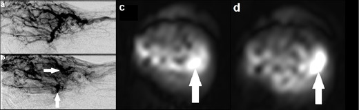 (a) Catheter angiogram demonstrating an AVM involving the right hand with evidence of arteriovenous shunting; (b) catheter angiogram at a slightly later time point identifying two discrete niduses (solid arrows); (c, d) Axial ASL images at different slices demonstrating two separate foci of intensely high signal (solid arrows), corresponding with the niduses seen on catheter angiogram and providing evidence of high flow. ASL, arterial spin labeling; AVM, arteriovenous malformation.