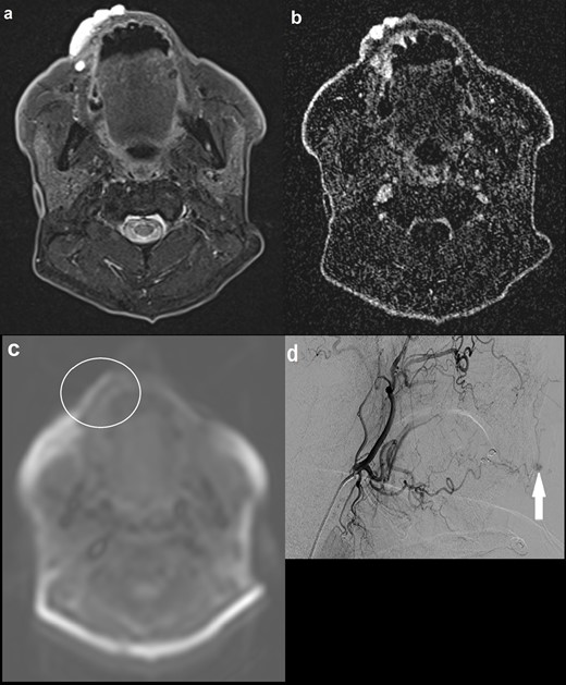(a) Axial STIR image demonstrating a 4.2 cm hyperintense lesion involving the right upper lip; (b) axial MRA (TWIST) image at approximately the same level showing maximal enhancement in the late images, with no definite arterial feeders or draining veins; (c) axial ASL image demonstrating normal signal intensity within the lesion. There is artefactual high signal at the outer border of the lip (not corresponding to the lesion) and elsewhere at the edges of the image; (d) carotid catheter angiogram showing maximal contrast opacification of the lesion in the delayed phase (solid arrow), with capillary type feeding vessels arising from the lingual artery and no large draining vein. No communication with the intracranial circulation. Appearances were in keeping with a low-flow verrucous vascular malformation, thought to be a predominantly venous malformation. ASL, arterial spin labeling; STIR, short tau inversion recovery.