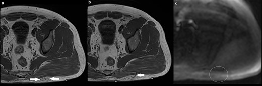 (a) Axial T1 image demonstrating a small cluster of veins in the superficial subcutaneous tissue overlying the left gluteus maximus muscle (solid arrow), with no intramuscular component. There was fat suppression in between the cluster of veins (not shown); (b) axial T1 image at a different level showing one of the two draining veins traversing the gluteus maximum muscle (solid arrow), going onto communicate with normal-sized gluteal veins; (c) axial ASL demonstrating normal signal intensity in the region of interest (outline by a white circle). There is artefactual high signal at the edges of the image. ASL, arterial spin labeling.