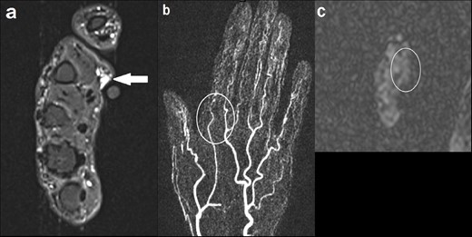 (a) Axial STIR image demonstrating a small cluster of vessels in the subcutaneous tissue overlying the palmar aspect of the second metacarpal head, measuring 7 × 9 mm (solid arrow). No involvement of the underlying musculature; (b) coronal MIP image of dynamic MRA (TWIST) at the level of the lesion demonstrating no enhancement in the early arterial phase or arterial feeders (outline by the white circle); (c) axial ASL showing normal signal intensity in the region of interest (outline by the white circle). ASL, arterial spin labeling; MIP, maximum image projection; MRA, MR angiography; STIR, short tau inversion recovery.