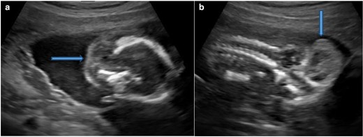 Ultrasound. Axial section (A) and Oblique coronal section (B) of fetal brain showing occipital encephalocele (block arrow).
