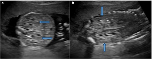 Ultrasound. Axial section (A) and Coronal section (B) of the abdomen showing bilateral enlarged and echogenic kidneys with few small cysts (block arrows).