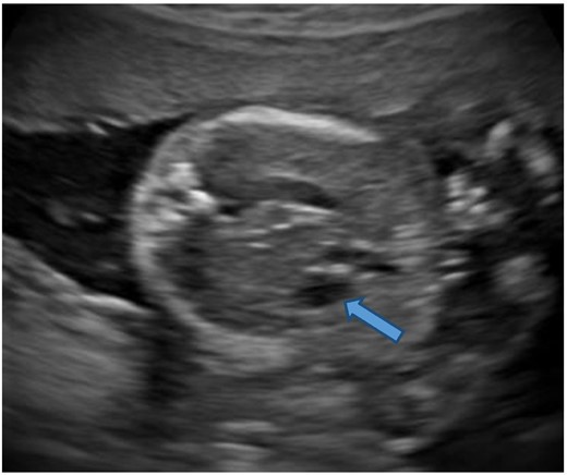 Ultrasound. Axial section of the upper abdomen shows a small hepatic cyst (block arrow).