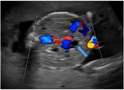 Color Doppler shows no color within the cystic structure (block arrow) in the liver suggesting a hepatic cyst.