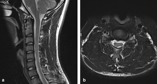 (a) T2W sagittal image of the cervical spine in a neutral position demonstrates loss of normal cervical curvature and localised cord atrophy at the C5–C7 level (b) T2W axial image in a neutral position at the C6/7 level demonstrates asymmetrical thinning of the cord, more pronounced on the left, with intrinsic cord signal abnormality